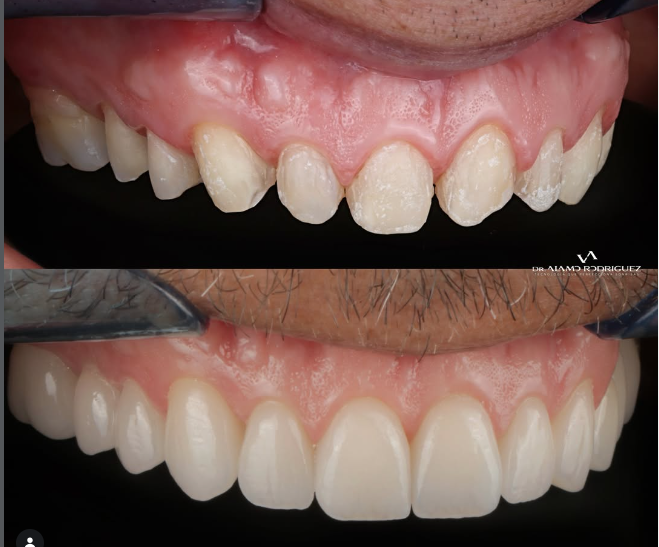 Comparación antes y después de tratamiento dental en Álamo Atelier