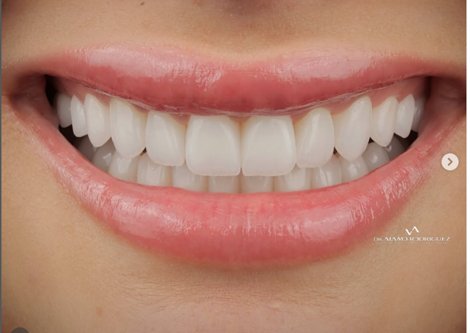 Resultado de diseño de sonrisa de paciente de Álamo Atelier